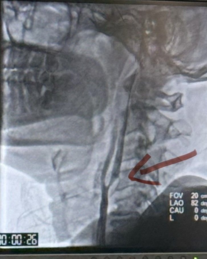 DSA angiographic imaging of the carotid artery during stenting