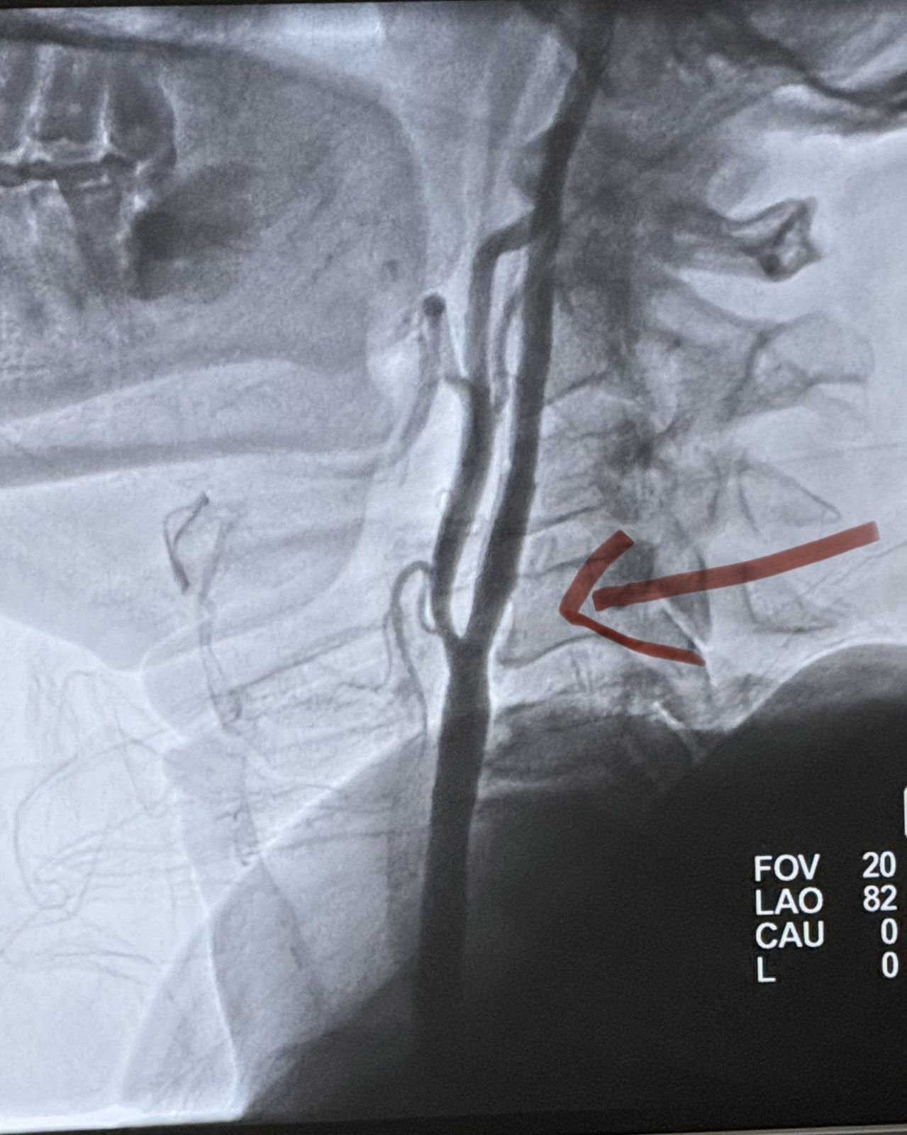 DSA angiographic imaging of the carotid artery during stenting, second view